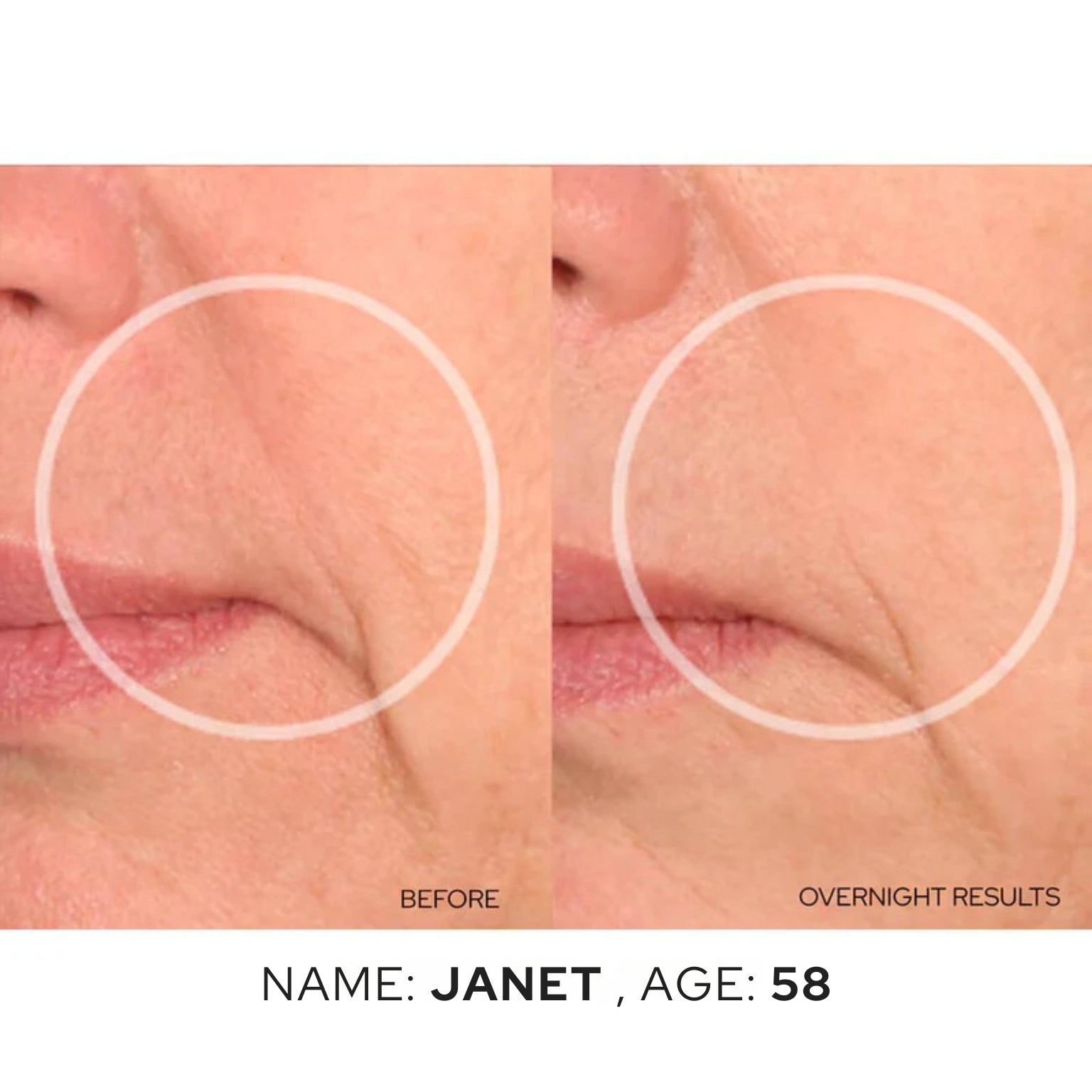 Vertical Lip Line Patches – Medical-Grade Silicone Smoothers